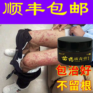 治疗顽固牛皮癣银屑廯头皮手足癣体股藓皮肤抑菌瘙痒止痒专用药膏