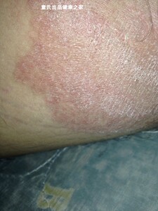 睾丸皮痒男人下面蛋蛋皮肤痒维生去鸡皮复方利卡多因软膏脸部红