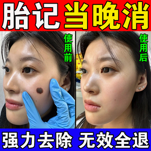 胎记去除神器脸上黑色素天生胎记咖啡斑淡化红色去祛除专用精油膏
