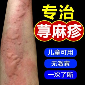 荨麻疹过敏止痒断根儿童成人急性慢性风团专用药皮肤瘙痒止痒膏寻