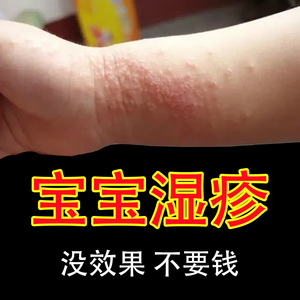 婴儿湿疹专用儿童奶藓痱子膏婴幼儿热疹宝宝湿疹皮肤治疗止痒去根