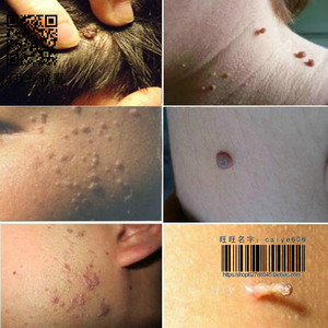 00 0人付款  淘宝 去猴子的药肉粒疙瘩祛鱼鳞痣休子治瘊子药脚