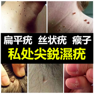 氟尿嘧啶软膏旗舰店正品五斑蛰素药乳膏5丝状疣扁平疣鬼臼毒素酊