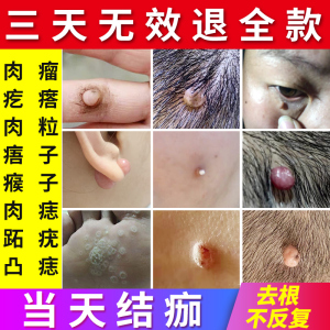 去除肉瘤肉疙瘩肉赘祛瘊子点痦子颈部丝状疣凸痣神器