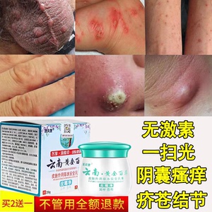 疥苍膏云南黄金百草阴囊结节一扫光去根除疥螨疥虫膏儿童成人专用