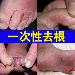 治疗脚气药膏去脚臭根神器治止痒脱皮杀菌除臭真菌感染水泡烂脚丫