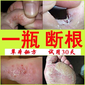 脚气脚藓药膏