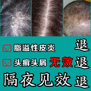 特效治头癣药膏治头部银屑癣专用头皮藓药去头皮屑洗发水抗真菌