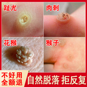 治瘊子药鱼鳞痣祛刺猴去除正品手足部去猴子肉粒疙瘩脚肉刺去除膏