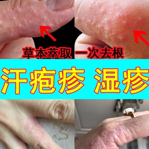止痒膏手脚水泡脱皮专用皮肤过敏抑菌瘙痒湿疹止痒去根牛皮癣药膏