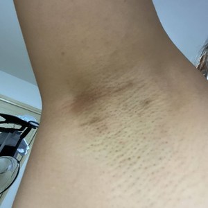 腋窝下皮肤胳肢窝痒胳膊皮痒灵腋下出汗臭湿痒康毒清肤痒净软膏