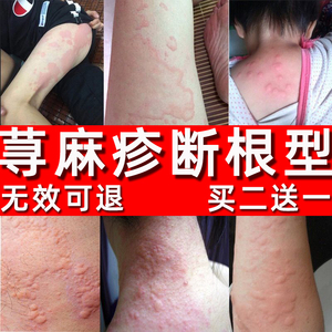寻荨麻疹过敏止痒断根喷雾儿童根源克星专用治风团脱敏药膏胆碱性