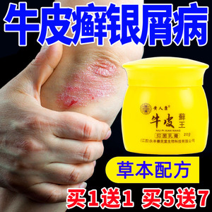 牛皮癣药膏银屑病止痒抑菌治疗皮肤外用瘙痒头藓体股手足癣特效药