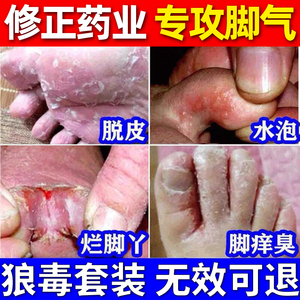 修正狼毒烂脚丫药脱皮糜烂脚趾缝烂痒治脚丫子止脚痒水泡脚臭喷雾