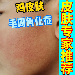 毛周角化症鸡皮肤疙瘩毛孔堵塞疏通毛囊角化脸儿童马拉色菌沐浴露