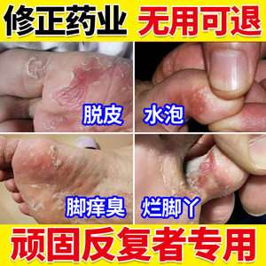 脚气止痒脱皮杀菌脚趾缝烂脚丫根专用水泡喷雾脚痒非神器药膏去治