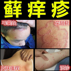 皮速康皮肤病药膏抑菌止痒湿疹去根皮肤瘙痒手臂小腿手掌起水泡