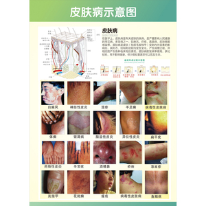 皮肤病墙贴纸皮肤疾病常见图谱贴纸医院皮肤科挂图宣传海报装饰画