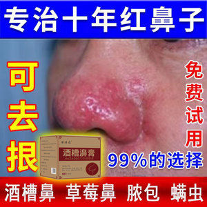 治疗酒糟鼻修复红鼻子专用药草莓鼻红血丝修复软膏去黑头除螨虫清