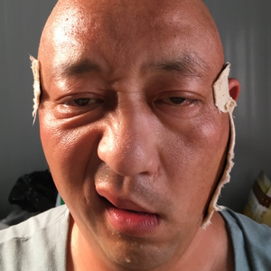 面瘫后遗症牵正贴膏专用药嘴歪眼斜散萎缩僵硬紧面肌痉挛透宝丹治