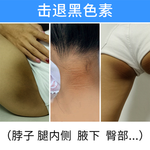 脖子正品腋窝颈部腋下去臀部黑全身屁股坐印去黑色素沉淀护理美白