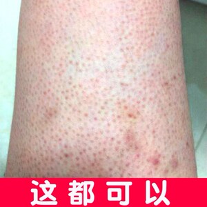 艾米女装工作室淘宝毛周角化去鸡皮肤疙瘩毛囊炎角质药膏去除神器