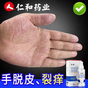鹅掌风药膏手脱皮药膏真菌感染蜕皮干裂水泡手痒手藓膏手气膏烂手