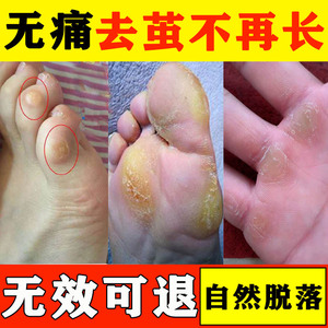 去除脚上长老茧手上脚起茧胼胝膏脚垫脚底死皮脚趾关节茧子软化剂