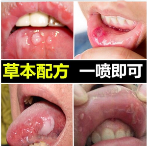 口舌生疮最快治疗方法图片