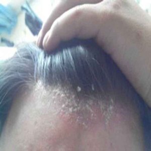 治疗头藓银屑病头皮癣藓真菌感染毛囊炎头皮藓头部专用药膏洗发水