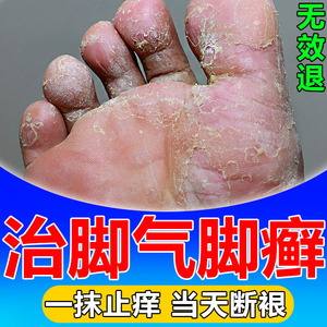 脚癣脚气去止痒根治疗香港脚的药一次净脚上起水泡痒掉皮脱皮专用