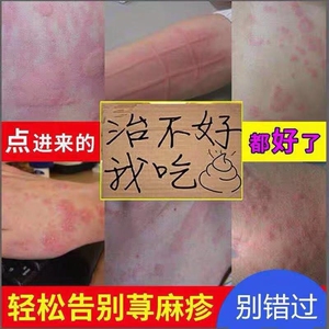 专用皮肤瘙痒过敏止痒风团荨麻疹日本进口荨麻疹丸外用断根中药膏