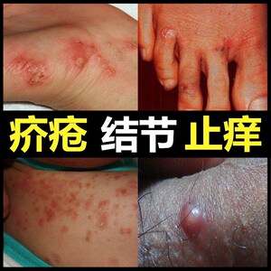 疥疮膏结节硫磺霜皮肤止痒抑菌阴囊大腿内侧瘙痒 皮肤瘙痒外用药