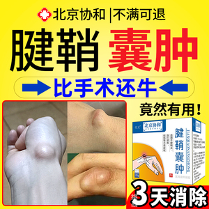 手腕腱鞘囊肿贴鼓包治疗特效健鞘炎痛舒筋贴腱鞘炎疼痛专用膏药yf