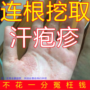 疥疮手脱皮药膏汗状疱疹小水泡鹅掌风真菌感染手气膏足藓癣王波勇