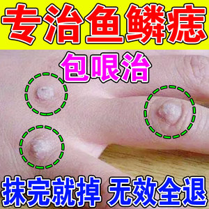 鱼鳞痣药膏去除扁皮疣点疣手指长疣石疣趾神器治疗猴子肉刺专用药