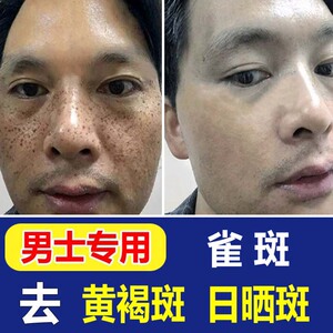 去雀斑男士