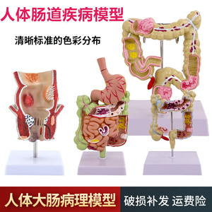 大肠病理模型大肠模型肠胃病变解剖模型肠道疾病人体结肠病变模型