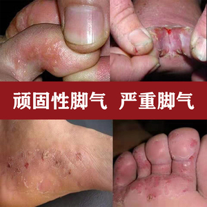 脚气脱皮止痒杀菌喷雾真菌水日本药根治止痒真菌感染水泡去根神器