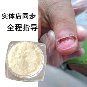 软甲膏灰指甲快速脱甲膏杀菌膏无痛溶甲膏去灰甲净去甲膏溶甲膏
