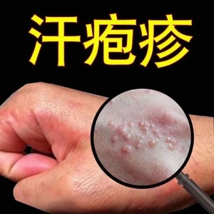 汗疱疹药膏手上小水泡专用疗治手痒脱皮湿疹手足癣菌真感染起去根