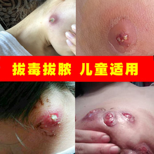 拔毒膏火疖子疮坐板疮肿硬块脓毒疮去除大红包药毛囊疮毒疮火痘痘