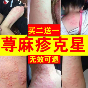 治疗寒冷胆碱能性寻荨麻疹过敏止痒断根克星专用药膏皮肤瘙痒外用