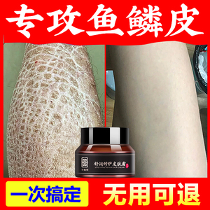 鱼鳞皮肤霜去鱼鳞克星皮肤干燥脱皮起皮腿上蛇皮肤角质保湿身体乳