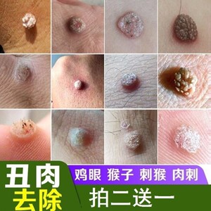 砣疣膏