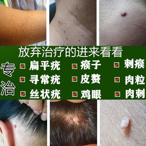 氟尿嘧啶软膏鸭胆子去瘊灵丝状疣去除神器疣滴去疣灵跖疣净肉瘤子