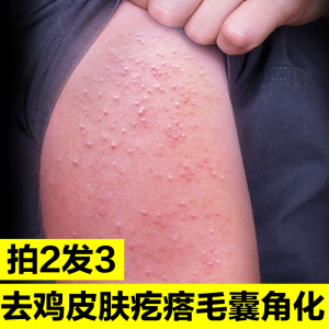 taogoods商城淘宝去除鸡皮肤疙瘩毛囊角化角质全身腿部手臂脸部毛周