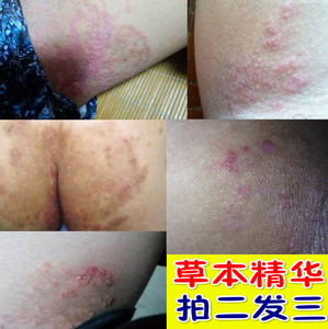 大腿内侧止痒药膏