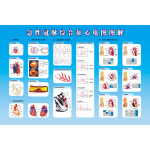 急性冠脉综合征心电图图解海报 心脏健康科普挂图内科科室装饰画