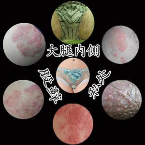 阴囊潮湿瘙痒去潮湿男士特效干爽成人私处止痒外用膏肛门肛周